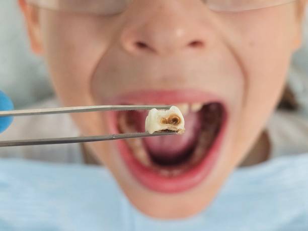 Best Knocked-Out Tooth (Avulsed Tooth) Treatment in Regency At Monroe, NJ